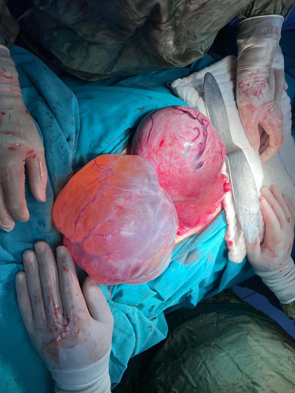 Yumurtalık Kanseri Ameliyatı